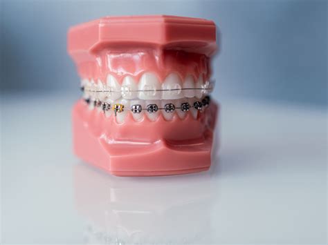 cheapest braces in saramento area